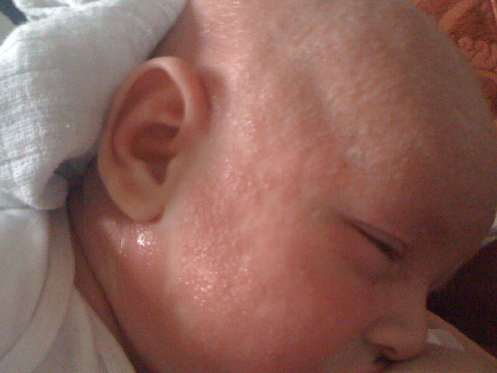 8 weeks old severe reaction - Callum at just 8 weeks old with a severe allergic reaction caused by CMPA. Covered in pus, very swollen face, and eyes like slits. www.intolerantgourmand.com
